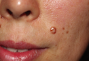 How to Remove Unwanted Moles and Skin Tags Without Visiting a Dermatologist